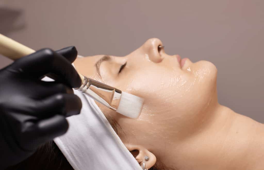 Peeling químico facial en Málaga