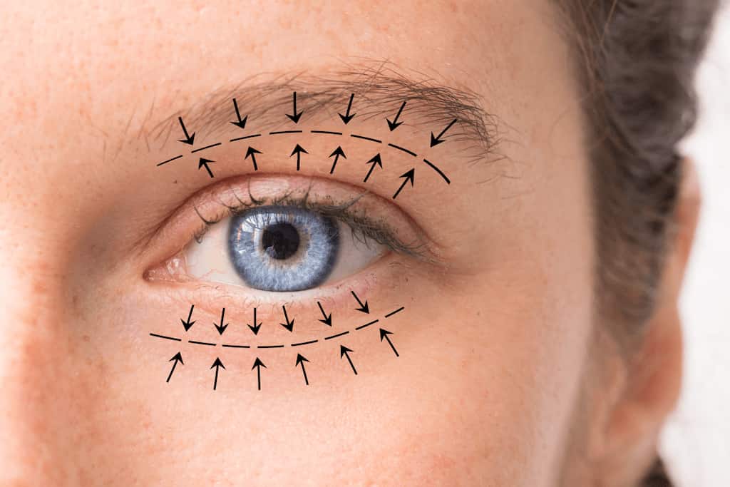 Blefaroplastia no quirúrgica