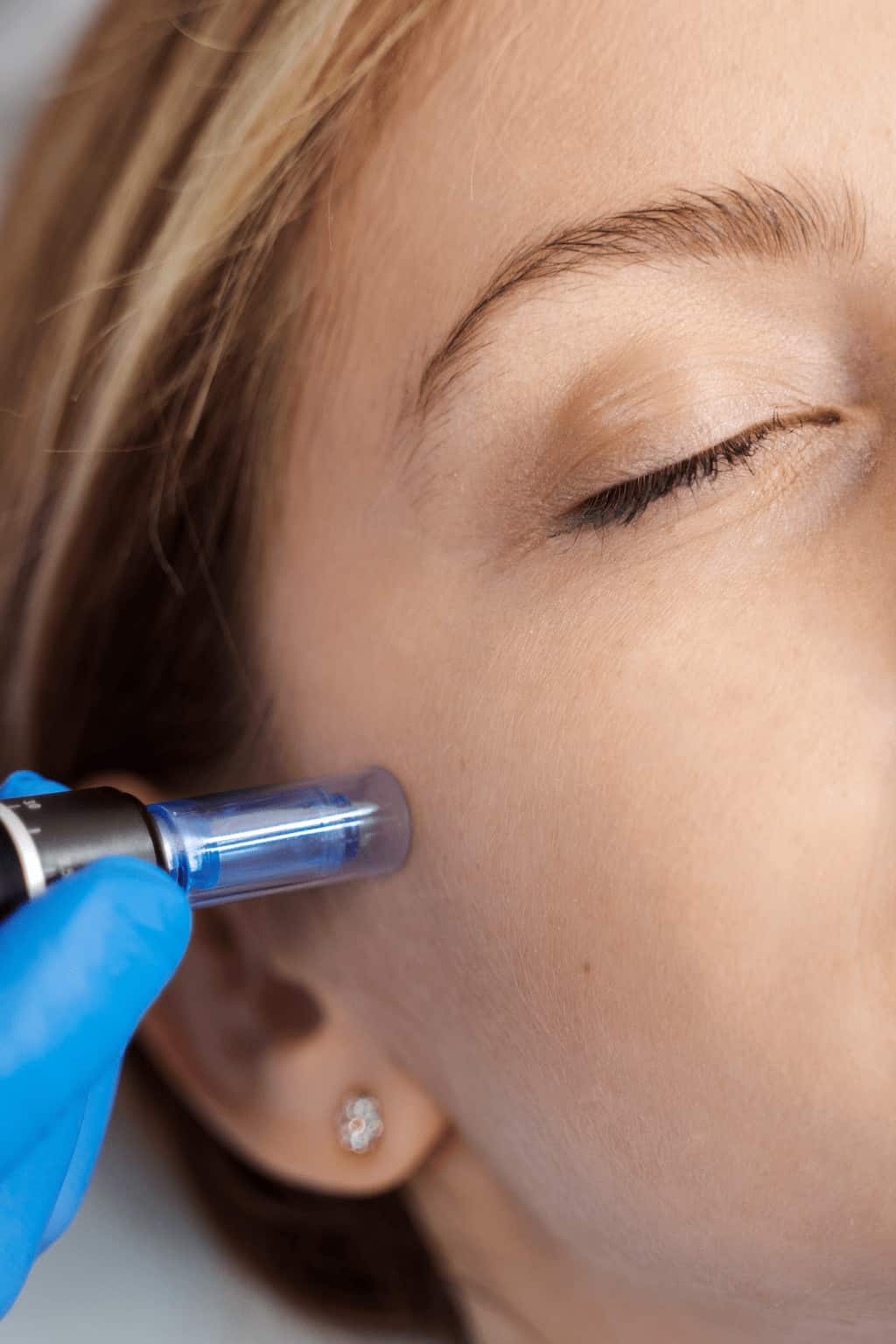 Dermapen microagujas en Málaga