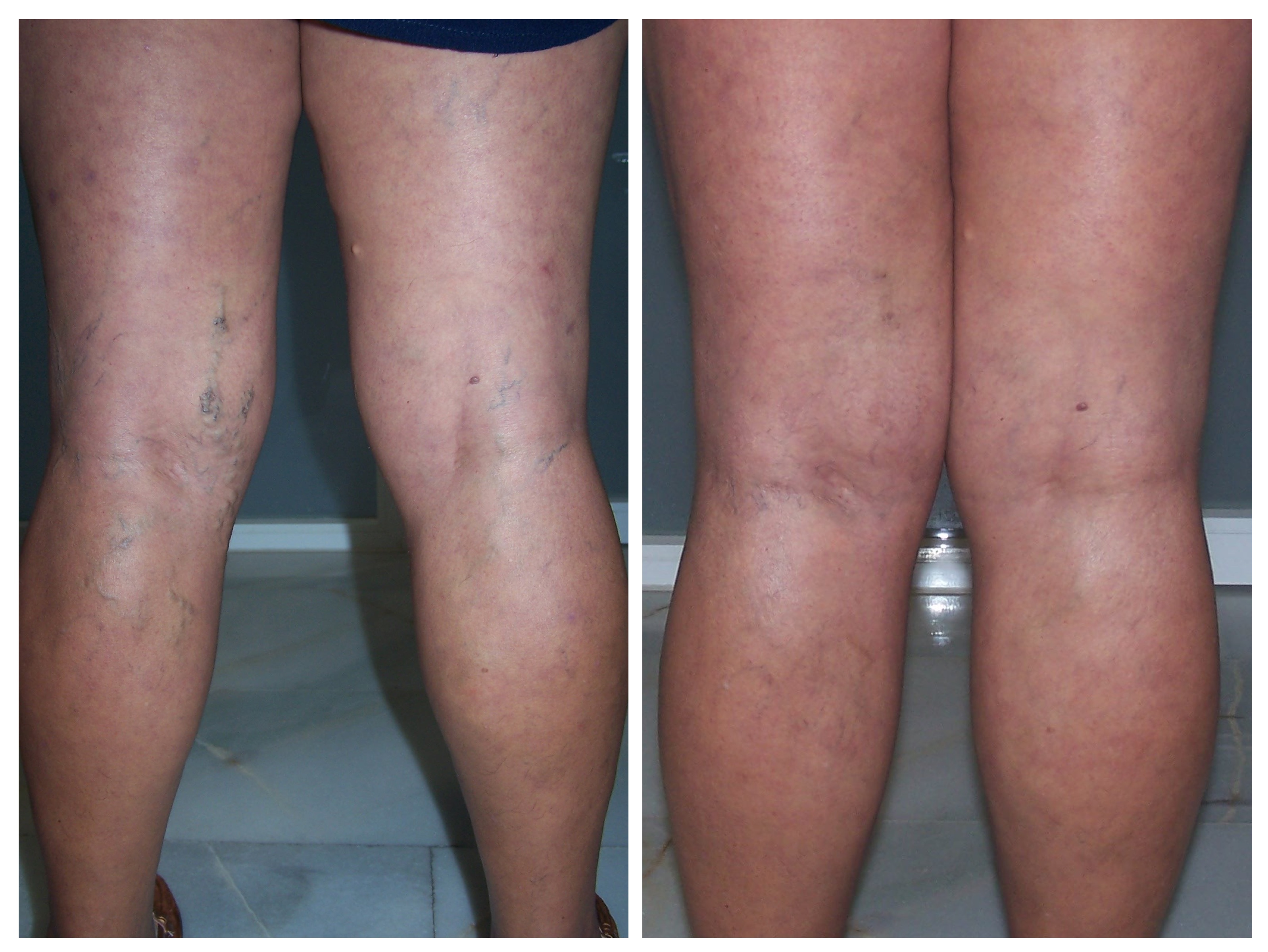 Resultado varices TRAP caso 2