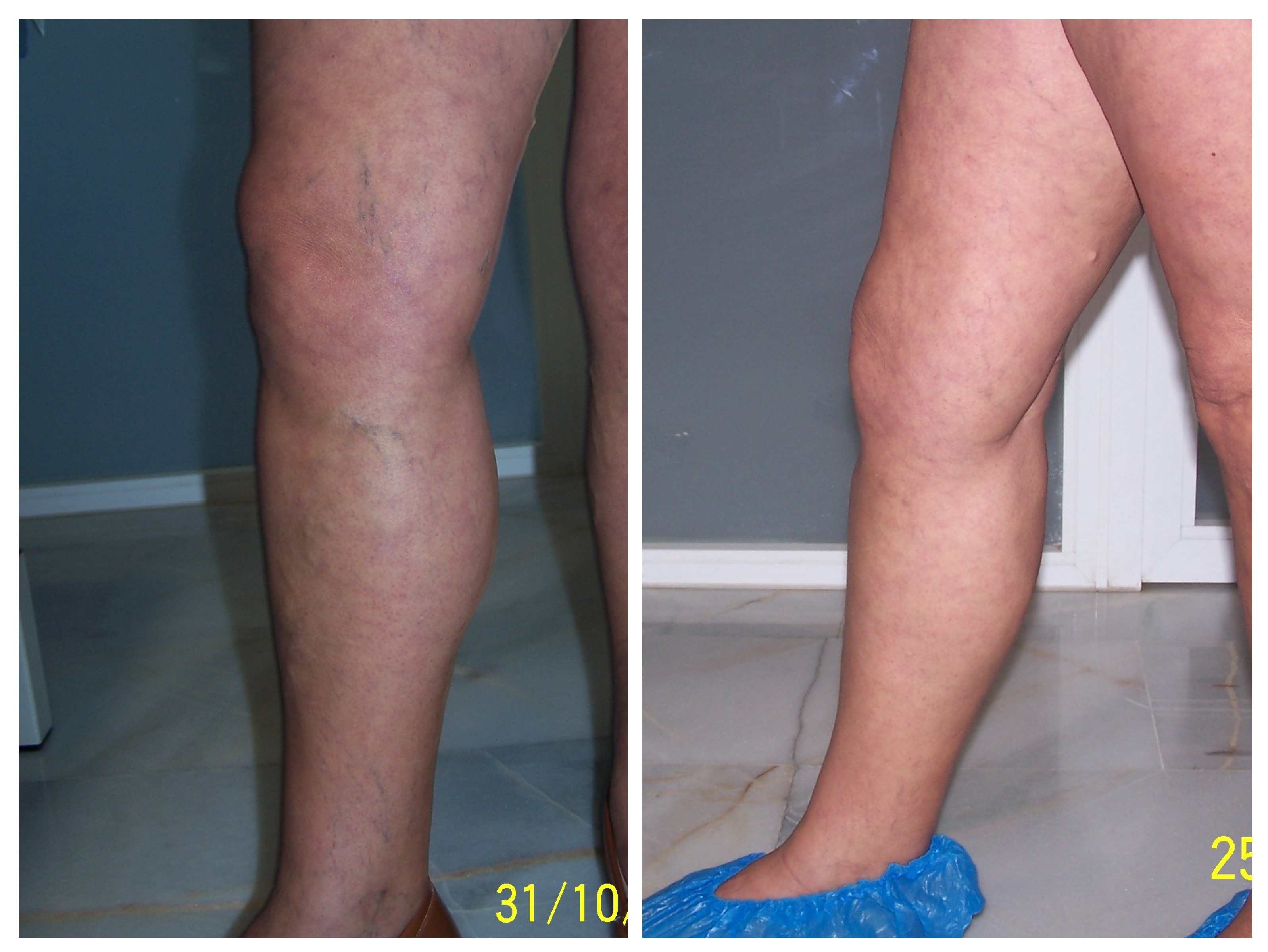 Resultado varices TRAP caso 6